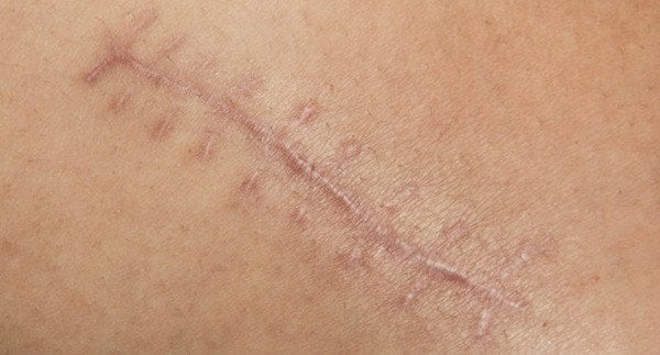 an example of a scar
