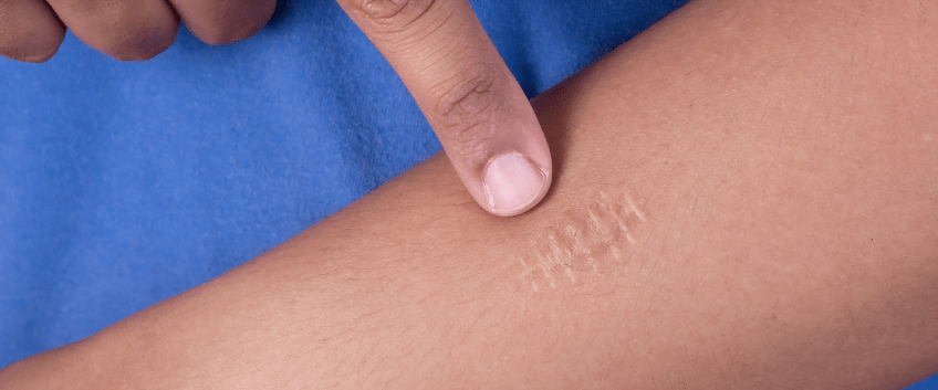 treatment of seam scars