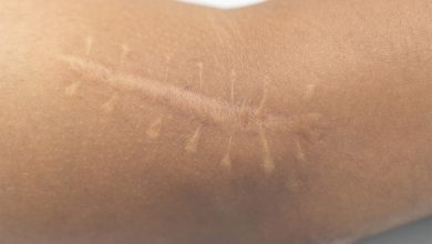 what is the treatment of seam scars