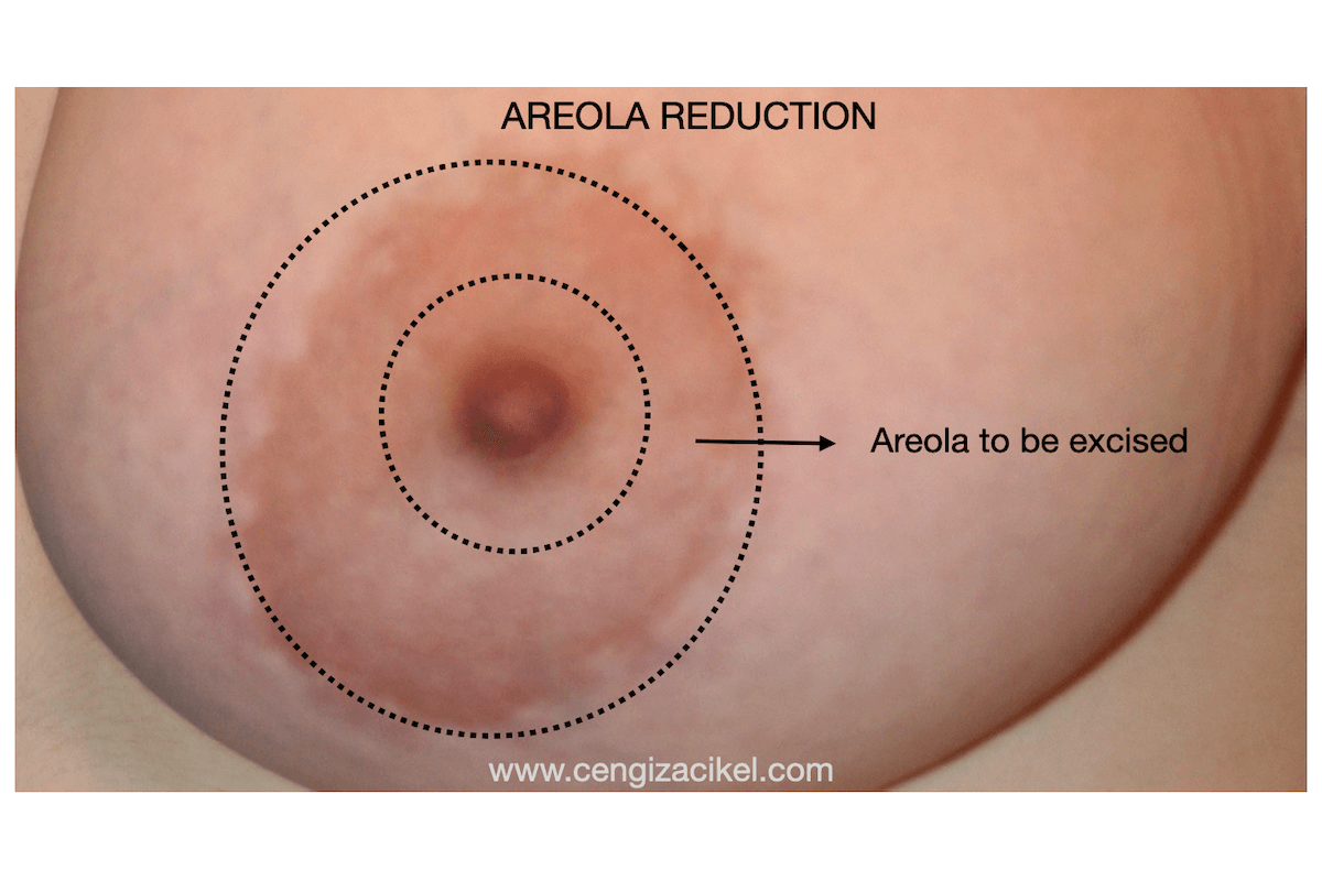 areola-reduction