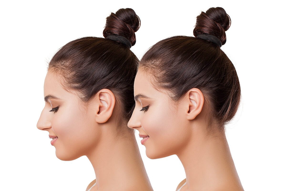 What is Secondary Revision Rhinoplasty?
